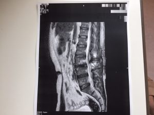 脊柱管狭窄症　手術　ボルト