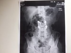 脊柱管狭窄症　手術　ボルト　レントゲン写真