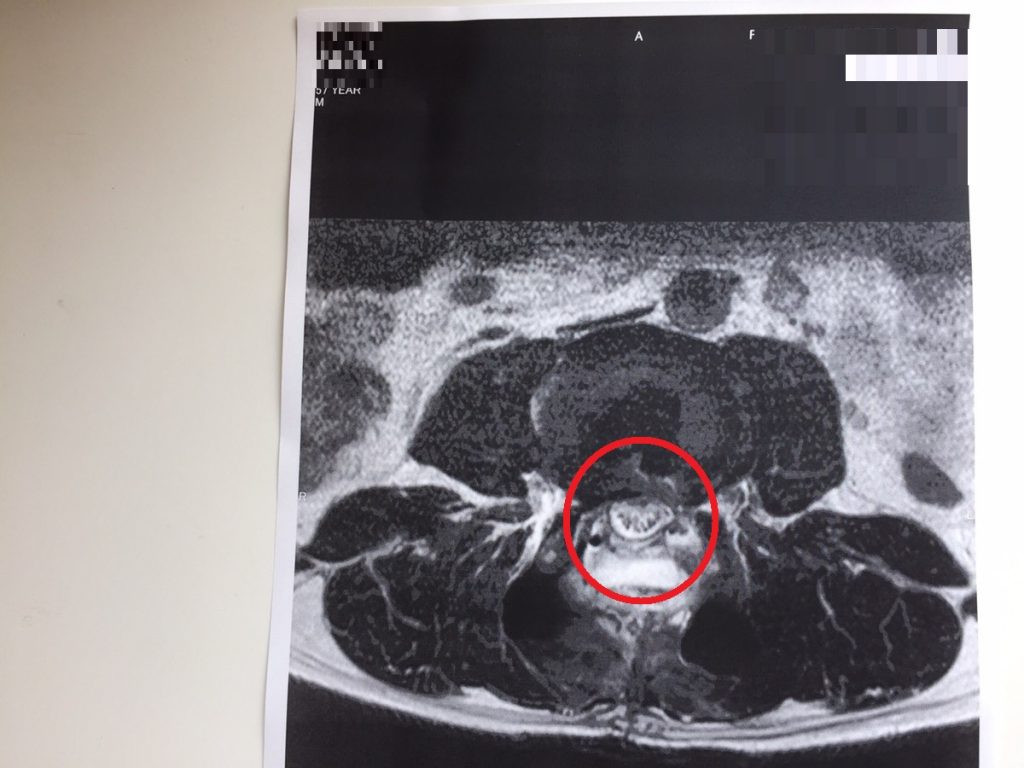 脊柱管狭窄症　MRI画像　レントゲン写真