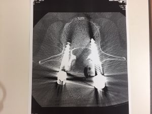 脊柱管狭窄症　ボルト　CT画像　レントゲン画像