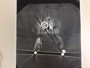 脊柱管狭窄症　ボルト　CT画像　レントゲン画像