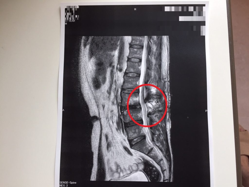 脊柱管狭窄症　MRI画像　レントゲン写真
