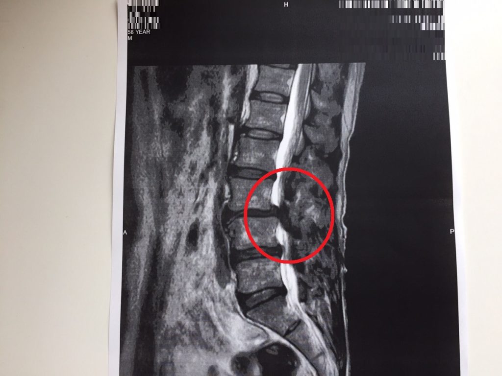脊柱管狭窄症　MRI画像　レントゲン画像