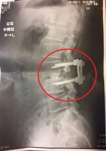 脊柱管狭窄症　手術　写真